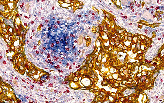 Lung Adenocarcinoma: PD-L1, CD8, PanCK. PD-L1 on infiltrate.